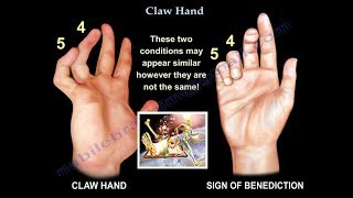 Claw Hand Ulnar Claw Hand  Everything You Need To Know  Dr Nabil Ebraheim [upl. by Ssalguod655]