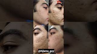 Successful Treatment Of Acne Scars skincare acnescars deepscars scars [upl. by Ivey]