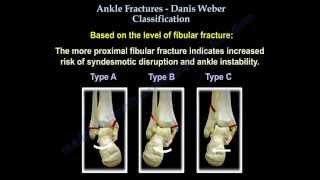 Ankle Fractures Danis Weber Classification  Everything You Need To Know  Dr Nabil Ebraheim [upl. by Ahsieyt953]