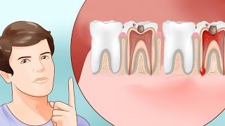 6 Proven Ways to Stop a Toothache and Relieve Pain [upl. by Anelej349]