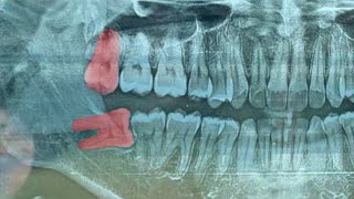 Removal Of 2 Wisdom Teeth At Once  Odontectomy  Geraham Bungsu  Dentist  Dokter Gigi Tri Putra [upl. by Kieryt]