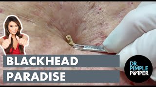 Blackhead Paradise [upl. by Clabo]