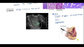 Endometrial Cancer and Hyperplasia for USMLE [upl. by Angel]