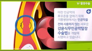 ENGJPN SUB 국소마취로 하는 강윤식 무인공막 탈장수술법no mesh hernia surgery 애니메이션 [upl. by Ozne]