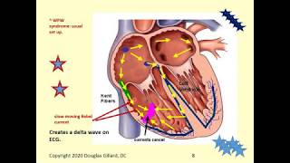 WolffParkinsonWhite Syndrome AVRT and AVNRT Common causes of Supraventricular Tachycardias [upl. by Simonetta]