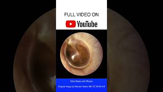 Otitis Media with Effusion Otoscopy [upl. by Polik]