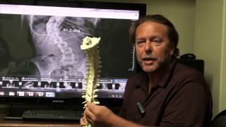 Scoliosis Correction [upl. by Johan581]