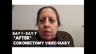 Post Coronectomy Video Diary Day 1 to Day 7 [upl. by Malti]