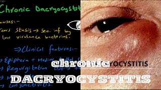 Chronic Dacryocystitis  lacrimal system [upl. by Yenaled]