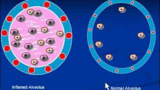 Pneumonia Streptococcal Pneumonia [upl. by Naiditch]