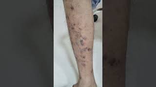 PRURIGO NODULARIS PN skincare dermatology disease healing viralvideo shorts disease [upl. by Just]