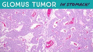 Glomus Tumor in STOMACHsoft tissue pathology gastricgastrointestinal tumor [upl. by Evadne]