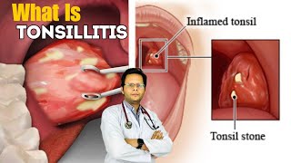 Tonsillitis  Causes Signs Treatment Symptoms In Hindi [upl. by Carberry]