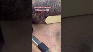 Laser Hair Removal getsmarthairclub viralvideo [upl. by Yenmor]