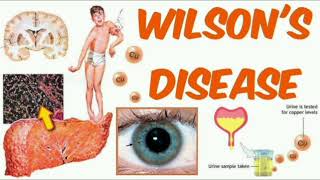 Wilson disease History mrcpch Clinical [upl. by Aikan439]