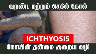 ICHTHYOSIS நோயின் தன்மை குறைய வழி  JKT SKIN [upl. by Annibo]