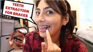 TEETH EXTRACTIONS FOR BRACES [upl. by Sesiom]