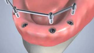 Prothèse dentaire sur implants [upl. by Baskett]