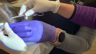 Scalp Biopsy to determine cause of hair shedding  Dr Nicole Rogers [upl. by Eiroc313]