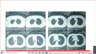 Discusión 58 Presentación de cancer de tumor germinal extragonadal Dr Merlin Villatoro [upl. by Hehre]