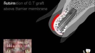 Clinical application of the Dentium graft materials [upl. by Cedell]