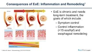 The Latest on New Options for Eosinophilic Esophagitis Considering Targeted Biologic Therapy [upl. by Starbuck]