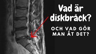 Vad är diskbråck och vad gör man åt det [upl. by Zanze]