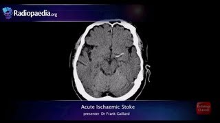 Stroke Acute infarction  radiology video tutorial CT MRI angiography [upl. by Lowry19]