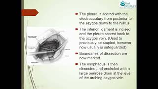 Open Ivor Lewis Esophagectomy  Surgical Steps [upl. by Eilloh927]