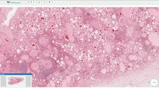 Chronic Pyelonephritis  Kidney Histopathology [upl. by Ihskaneem545]