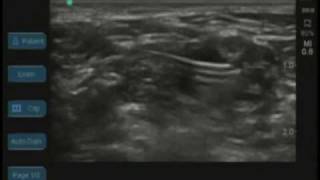 Ultrasound Guided Interscalene Catheter [upl. by Annawahs]