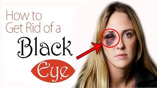 How to Get Rid of a Black Eye Fast at Home  Home Remedies for Black Eye Treatment [upl. by Landre]