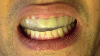 Bruxism Splint  Part 6  Insertion and Occlusion [upl. by Idell200]