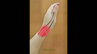 De Quervains Tenosynovitis Quick Fix in 5 Steps [upl. by Rasecoiluj658]