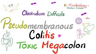 Pseudomembranous Colitis amp Toxic Megacolon  Clostrdium difficile  Microbiology 🧫 [upl. by Earesed]