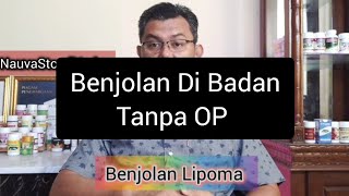 Benjolan Lemak Di Bagian Badan Lengan Lipoma Tanpa OP [upl. by Iliram]