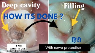 How Deep cavity filling done with nerve protection  pulp capping  Treatment of sensitive cavities [upl. by Leuqim102]