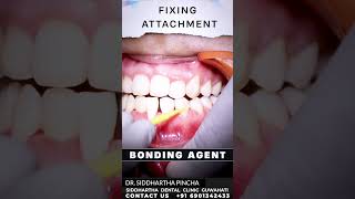 How Aligner are fixed step by step  Guwahati Braces Aligners shorts ytshorts viralreels [upl. by Oni]