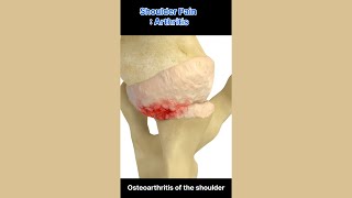 Shoulder Pain  Arthritis [upl. by Kaete]