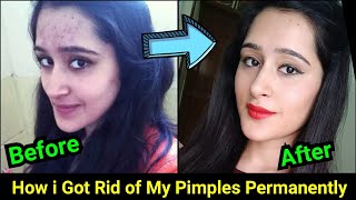 How to Remove Pimples Acne Pimple Marks completely  ThatGlamGirl [upl. by Aniat]