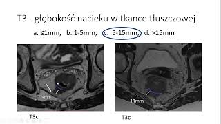 A Hołdakowska  Diagnostyka raka odbytnicy w MR – wytyczne i zalecenia [upl. by Manuela727]