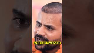 Youtuber Topa Bhai  Nadeem Bunny  Hair Transplant Progress shortshairtransplant [upl. by Tripp]