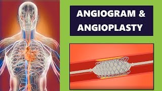 Angiogram and Coronary Angioplasty Procedure Cardiology [upl. by Chaney]