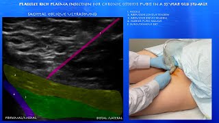 Ultrasound of Platelet Rich Plasma Injection for Osteitis Pubis in a 35 Year Old Female [upl. by Knowland]