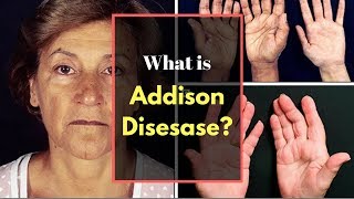 Addison Disease Symptoms  Causes Pictures Signs and Symptoms of Addisons Disease [upl. by Dobrinsky336]