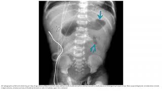 Duodenal Atresia or Stenosis Imaging [upl. by Ahsataj]