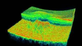 Topcon 3D OCT  Soft Drusen [upl. by Irollam]