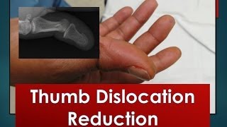 Thumb Dislocation Reduction [upl. by Ettegdirb]