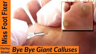 SATISFYING THICKEST AND GIANT CALLUSES REMOVAL [upl. by Irianat]