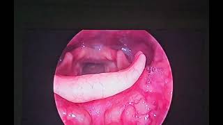 laryngeal papilloma papillomavirus hoarseness cough entsurgeon drbaisalisarkar kolkata [upl. by Inaliel204]